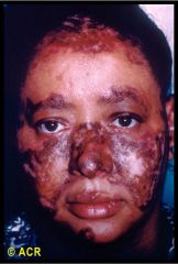 What type of rash is seen here (chronic/acute/subacute)? What condition can occur if this rash is found on the surface of the head?