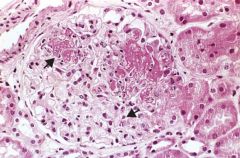 What is this type of Lupus Nephritis? How can you tell? 

What is the PREDOMINANT type of Immune complex (IC) deposit here?