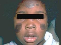 Discoid Lupus Erythematosus (NOT involving other organs).

SLE might develop many years later.