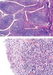 What is the main problem seen in RA and shown in this biopsy 

Describe the pathogenesis.