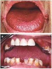 If a patient had this alone (along with keratoconjunctivitis sicca), what type of disease would you suspect?