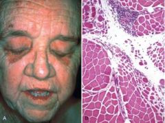 What are important features of this condition depicted in these two images? 

What do you have to worry about with these patients?