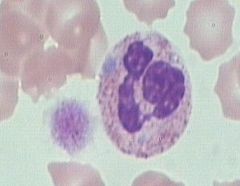 AD, GIANT platelets, thrombocytopenia, and WBC inclusions (Dohle body-like)

You can tell that it’s not Dohle b/c not seen in infection and patient doesn’t bleed typically.