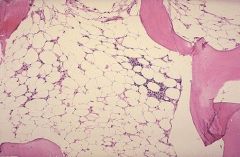 What condition is shown in this image? How do you calculate cellularity of the bone marrow?