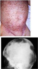 What is this condition called and how can you tell? What age group is most commonly affected?