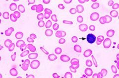 What type of anemia is shown here? How can you tell? What does the arrow point to? What is the MCV?