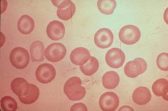 Thalassemia (problem in globin production). Target cells = large. Macrocytic.