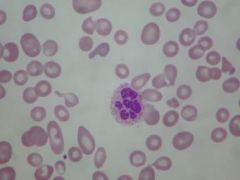 What type of anemia is shown here? What would the MCV be? What about the retic index?