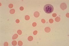 What are these cells called? What two conditions are characterized by these cells? 

What RBC index would you expect to be elevated?