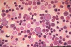 When do you examine Bone Marrow in a patient with anemia?

What is beneficial about doing an aspirate? a biopsy?