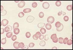 This condition is seen in Iron deficiency anemia when a person is being treated with Fe supplementation. It can also be seen in post transfusion syndrome.
