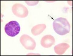 What type of cell is the arrow pointing to? What makes the cell this color?

Exposure to what can cause increased number of these cells? If you don't see the production of these cells in a patient with Sickle cell, what do you suspect?