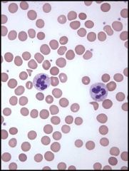 What types of cells are seen here? What major conditions are associated with such cells?