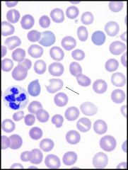 What condition are the following cells seen in? Why do the cells get this shape?

What are the precursor cells to this condition called.