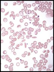 What cells are shown here? What is the viscosity of this individual's blood?