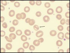 What type of cell is this and what broad category of anemia is this seen in?