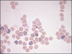 8 year old boy from Rhode Island presents with fever and thrombocytopenia. What organism might you see?

What if it was a 40 year old man from India with chronic cyclic fevers?