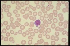 Looking at this smear, what thalassemia do you suspect this individual has?