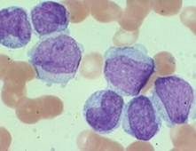 How are Acute and Chronic leukemia classified? 

How are they different? What is this a picture of?