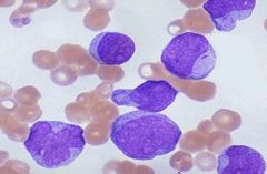 What characteristic features in this cell help identify the type of malignancy?