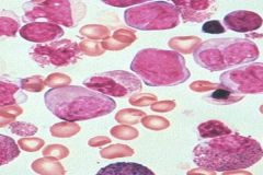 What type of leukemia might this person have (provide the FAB classification)? How can you tell? What would it possible stain positive for?