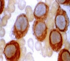 This type of leukemia stains positive for NSE (non specific esterase). What symptoms might it cause patients to present with?