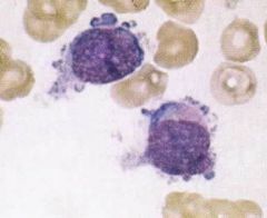 What type of Leukemia is this (include FAB classification)? What genetic condition might this individual have?
