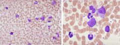 What is shown on this peripheral blood smear? 

Why does CML fail to remain in the indolent chronic phase?