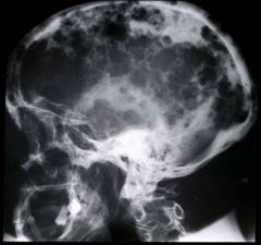 Describe this characteristic finding in Multiple Myeloma.

What bones are primarily affected? What lab value is notable?