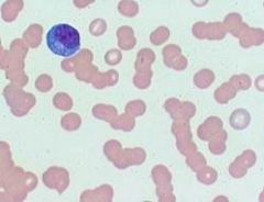 What is shown in this blood smear? 

What finding would patients present with who have this condition (hint- it's the A in CRAB)?