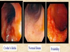 What gross morphologic characteristics of Crohn's is seen here?