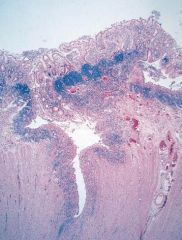 This is a gross histologic image of what Inflammatory Bowel disease? How can you tell? What is a complication of this condition?