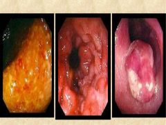 What are characteristic features of ulcerative colitis shown here?