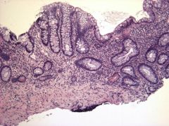 This is an image of a person treated with infliximab for ulcerative colitis. What changes can you see in the colon?

What is the most dangerous long term complication of Inflammatory bowel disease?