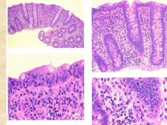 What are two types of Microscopic colitis?

Which is shown above? What demographic does it tend to affect?