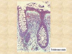Collagenous colitis (note the thickened basement membrane full of collagen)

Trichrome stain for collagen helps identify it. Unknown etiology (may be autoimmune).