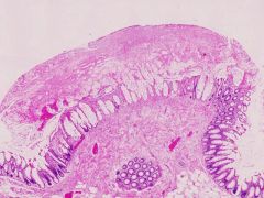 What does this biopsy show?

What would be an appropriate treatment for the patient?
