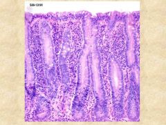What are some characteristic histologic features of Celiac Sprue (i.e Gluten Sensitive Enteropathy)?

What area is most affected?
