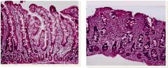 What are the three characteristic changes seen on the right histologic specimen (left is normal)?

What is the disease?