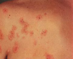 A patient is having weight loss, abdominal pain, and diarrhea. They have developed a  papular vesicular rash on their extensor surface that is incredibly itchy.  What is the treatment?