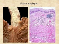 Describe the normal esophageal path seen on gross level and on histology.