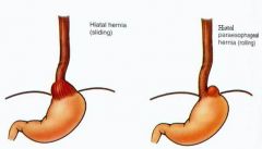What is the most common type of hiatal hernia? 

What is a common presenting symptom in these patients? Which type of Hernia would produce less symptomatology?