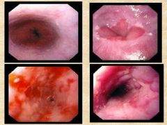 What do you see on the bottom endoscopic images? 

What are some causes for this condition?