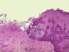 This is a biopsy from someone's esophagus. What condition would you suspect and how would it look on high powered examination?