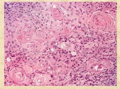 What type of cancer is this (based on histology alone)? 

What is prognosis in this cancer determined by?