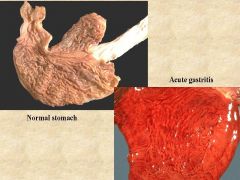 What changes do you suspect on histology in a person with acute gastritis?