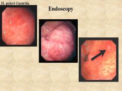 90% of Chronic gastritis is as a result of ______.

What are other causes of Chronic gastritis? What are some features seen on endoscopy?