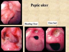 Where do 98% of ulcers in the body form (hint: two locations)?

What does it look like on histology?