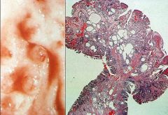 What are the histologic features of the polyp shown above?

Where in the stomach is it typically found and what condition is it associated with?