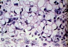 Diffuse type carcinoma (gives the stomach a leather bottle appearance, linitis plastica or diffuse gastric wall thickening) 

Signet ring cells found in the lamina propria (essentially globs of mucin within cell with eccentric nuclei).